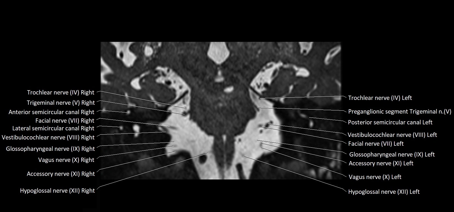 Cranial nerve cross sectional anatomy coronal 3T MRI image 43.webp